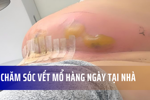 Cách chăm sóc vết mổ hàng ngày tại nhà