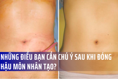 Sau khi đóng hậu môn nhân tạo: Điều gì cần biết và quá trình phục hồi