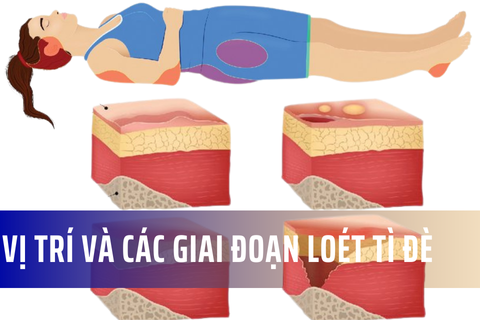 Loét da do tì đè - Phân biệt vị trí và giai đoạn loét
