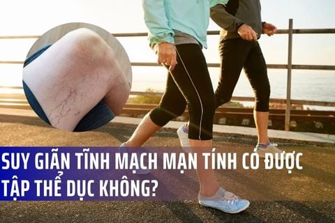 Suy giãn tĩnh mạch mạn tính có được tập thể dục không?