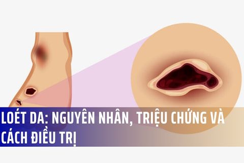 Loét da: nguyên nhân, triệu chứng và cách điều trị