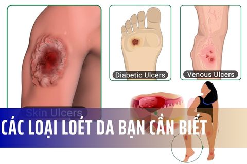 Tìm hiểu các loại loét da