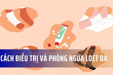 Cách điều trị và phòng ngừa loét da