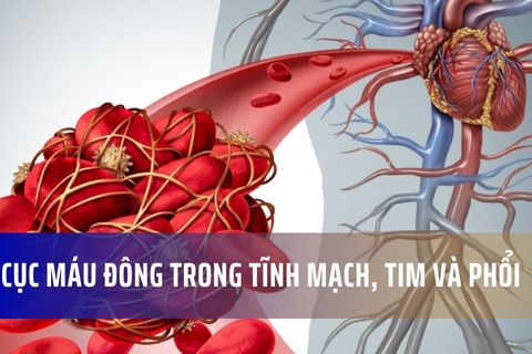 Cục máu đông trong tĩnh mạch, tim và phổi