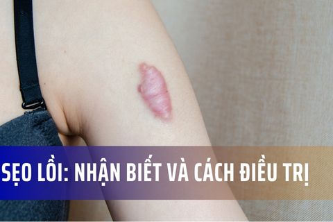 Sẹo lồi: Đặc điểm, nguyên nhân và cách điều trị