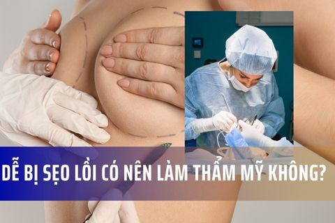 Dễ bị sẹo lồi có nên phẫu thuật thẩm mỹ không?
