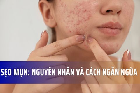 Nguyên nhân gây ra sẹo mụn và cách ngăn ngừa