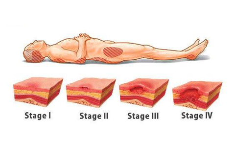 Loét tì đè – Phân biệt vị trí và giai đoạn loét