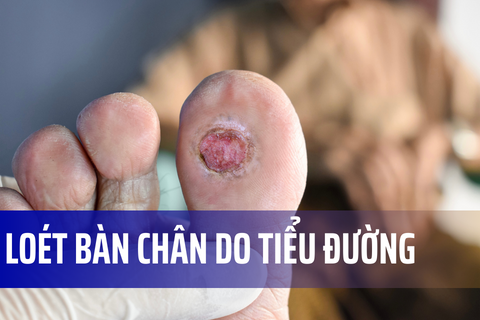 Q&A về Loét bàn chân do tiểu đường