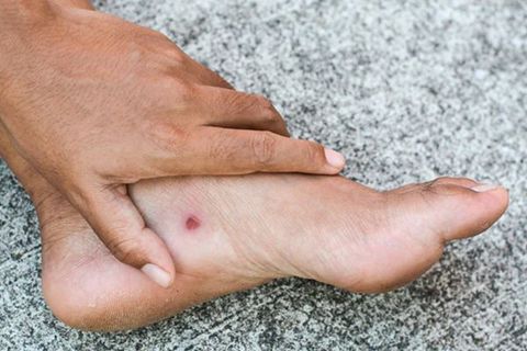Loét Da Và Cách Phòng Ngừa Hiệu Quả