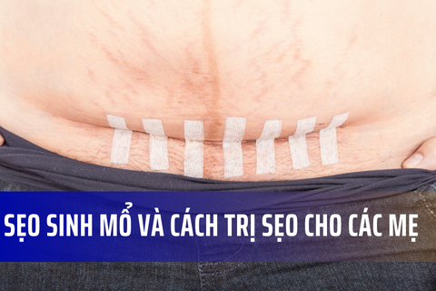 Sẹo sinh mổ và các cách trị sẹo dành cho các mẹ