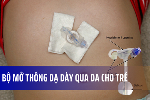 Ống mở thông dạ dày qua da cho trẻ (G-button)