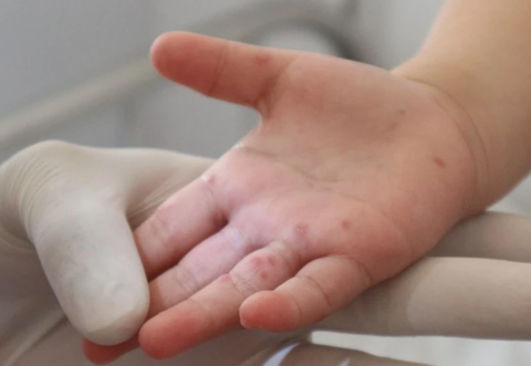 Đắk Lắk: Bệnh nhi 2 tuổi tử vong vì bệnh tay chân miệng