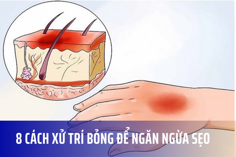 8 cách xử trí bỏng để ngăn ngừa sẹo