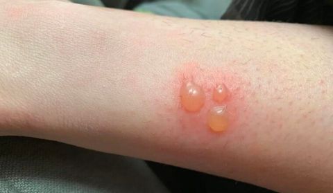 Vết bỏng bị phồng rộp: Cách xử lý đúng để nhanh lành