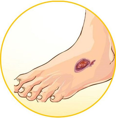 Các mẹo chữa lành vết thương và vết loét bàn chân do tiểu đường