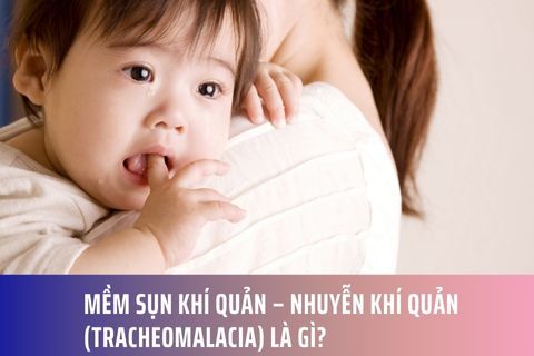 Mềm sụn khí quản – nhuyễn khí quản (Tracheomalacia) là gì?