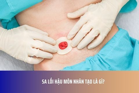 Sa lồi hậu môn nhân tạo là gì?