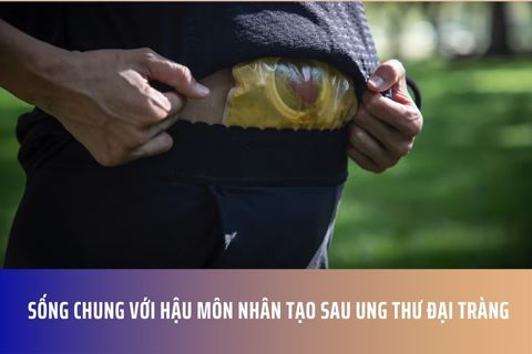 Sống Chung Với Hậu Môn Nhân Tạo Sau Ung Thư Đại Tràng
