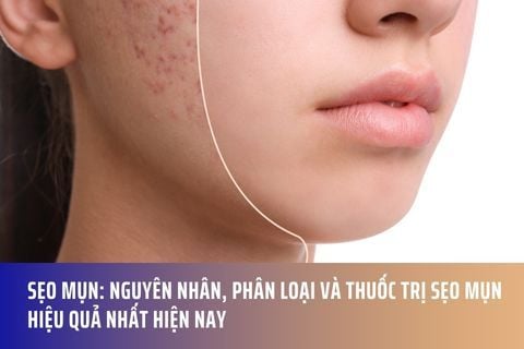Sẹo Mụn: Nguyên Nhân, Phân Loại Và Thuốc Trị Sẹo Mụn Hiệu Quả Nhất Hiện Nay