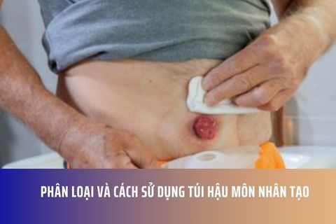 Phân loại và cách sử dụng túi hậu môn nhân tạo