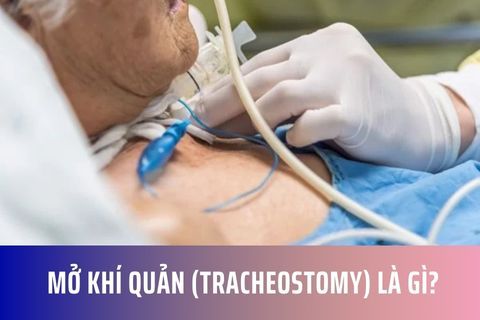 Mở khí quản (Tracheostomy) là gì?