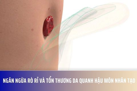 Ngăn Ngừa Rò Rỉ và Tổn Thương Da Quanh Hậu Môn Nhân Tạo