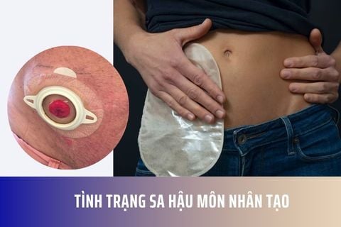 Tình Trạng Sa Hậu Môn Nhân Tạo