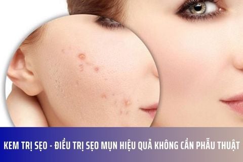 Kem trị sẹo - Điều trị sẹo mụn hiệu quả không cần phẫu thuật