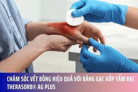 Chăm Sóc Vết Bỏng Hiệu Quả với Băng Gạc Xốp Tẩm Bạc Therasorb® Ag Plus