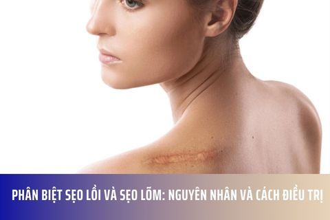 Phân Biệt Sẹo Lồi và Sẹo Lõm: Nguyên Nhân và Cách Điều Trị