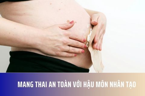 Mang thai an toàn với hậu môn nhân tạo