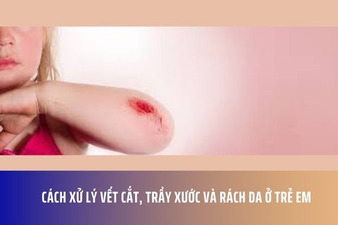 Cách xử lý vết cắt, trầy xước và rách da ở trẻ em