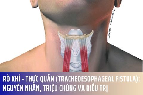 Rò khí - thực quản (Tracheoesophageal Fistula): Nguyên nhân, triệu chứng và điều trị