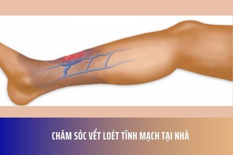 Chăm sóc vết loét tĩnh mạch tại nhà