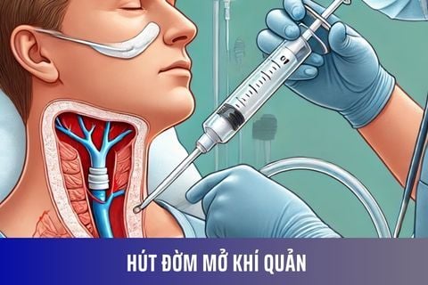Hút đờm mở khí quản