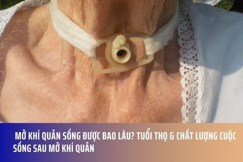 Mở Khí Quản Sống Được Bao Lâu? Tuổi Thọ & Chất Lượng Cuộc Sống Sau Mở Khí Quản