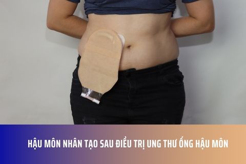 Hậu Môn Nhân Tạo Sau Điều Trị Ung Thư Ống Hậu Môn