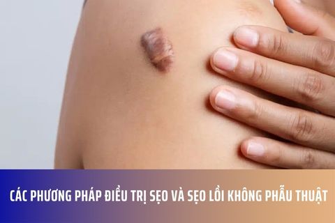 Các Phương Pháp Điều Trị Sẹo Và Sẹo Lồi Không Phẫu Thuật