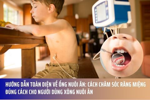 Hướng Dẫn Toàn Diện Về Ống Nuôi Ăn: Cách Chăm Sóc Răng Miệng Đúng Cách Cho Người Dùng Xông Nuôi Ăn