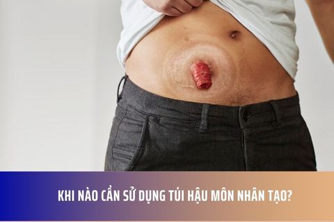 Khi nào cần sử dụng túi hậu môn nhân tạo?