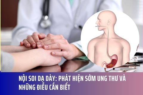 Nội soi dạ dày: Phát hiện sớm ung thư và những điều cần biết