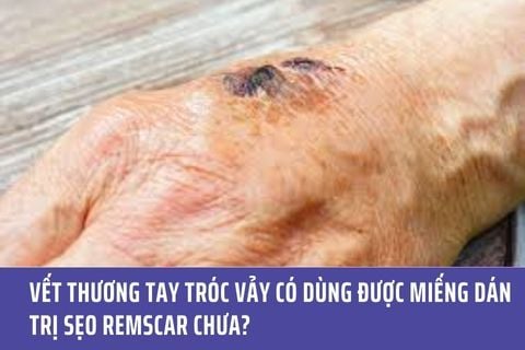 Vết thương tay tróc vảy có dùng được miếng dán trị sẹo Remscar chưa?