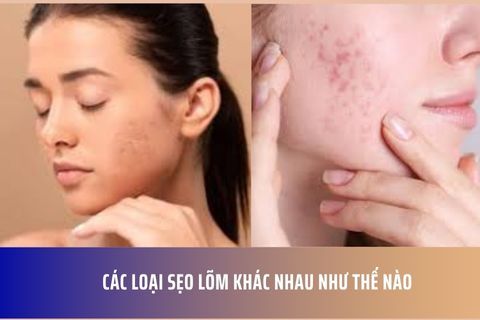 Các Loại Sẹo Lõm Khác Nhau Như Thế Nào
