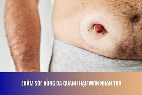 Chăm Sóc Vùng Da Quanh Hậu Môn Nhân Tạo
