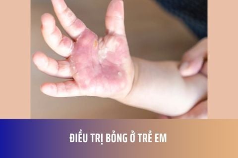 Điều trị bỏng ở trẻ em