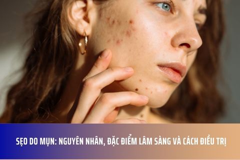 Sẹo do mụn: Nguyên nhân, đặc điểm lâm sàng và cách điều trị