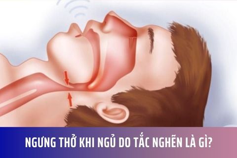 Ngưng thở khi ngủ do tắc nghẽn là gì?