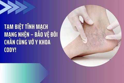 Tạm Biệt Tĩnh Mạch Mạng Nhện – Bảo Vệ Đôi Chân Cùng Vớ Y Khoa Cody!