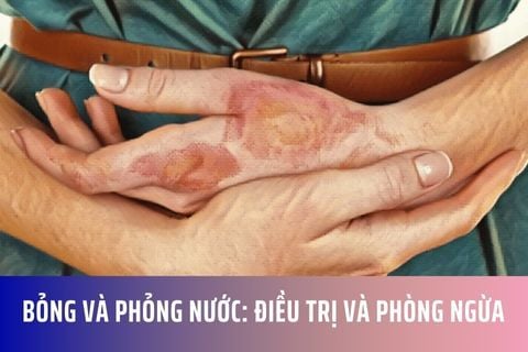 Bỏng và Phỏng Nước: Điều Trị và Phòng Ngừa